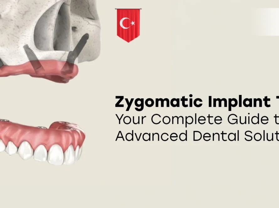 Zygomatic Implant Turkey