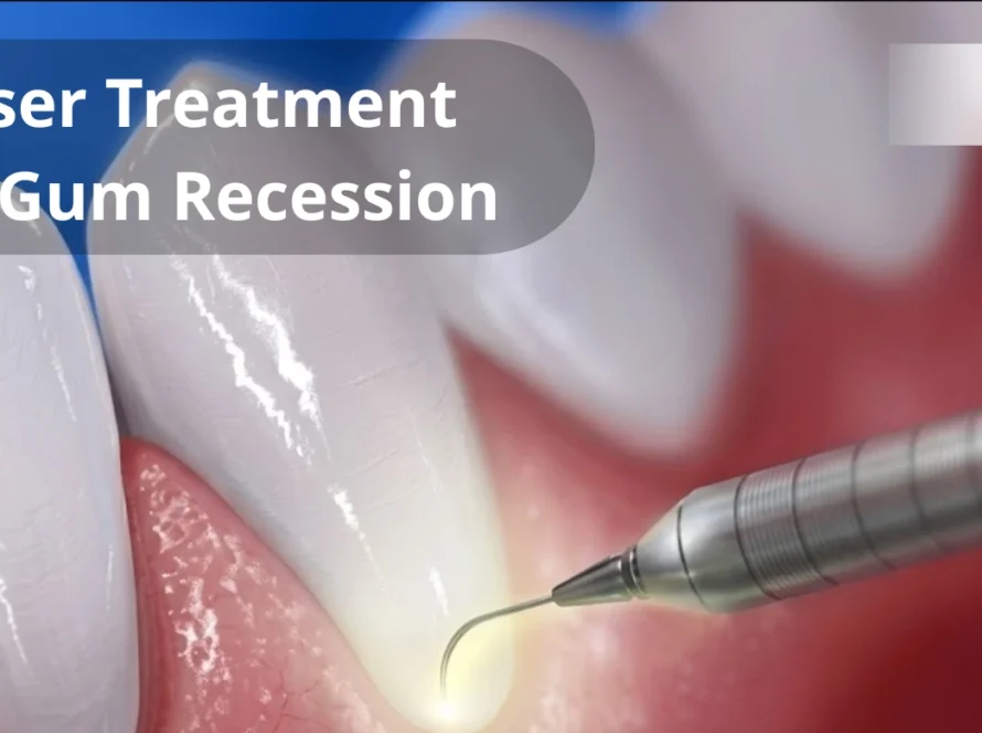 Laser Treatment for Gum Recession