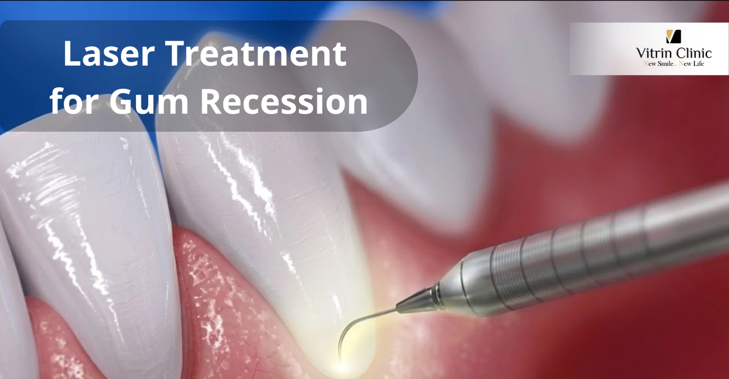 Laser Treatment for Gum Recession
