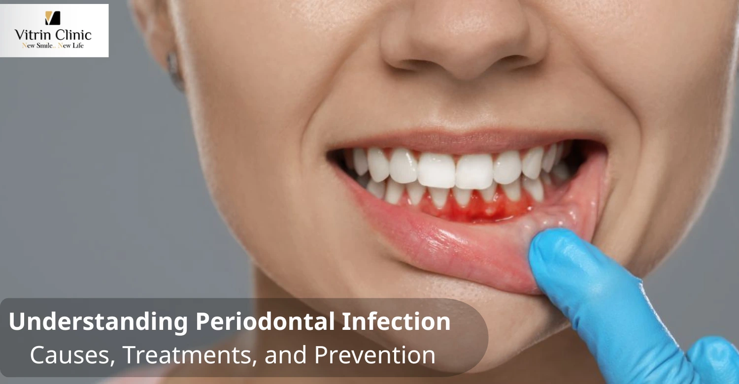 Periodontal Infection