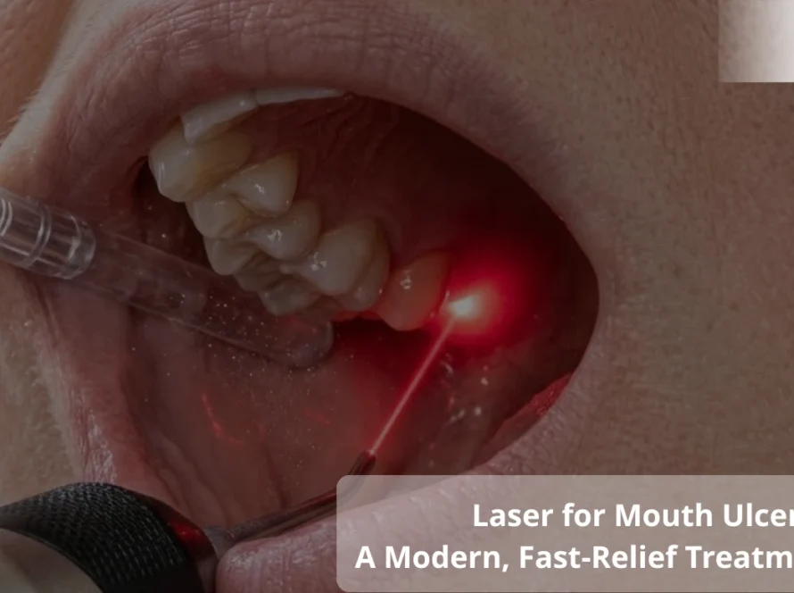 Laser for Oral Biopsies